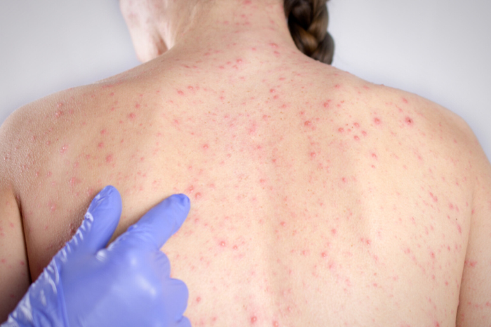 Two suspect cases measles recorded in Moldovan cap