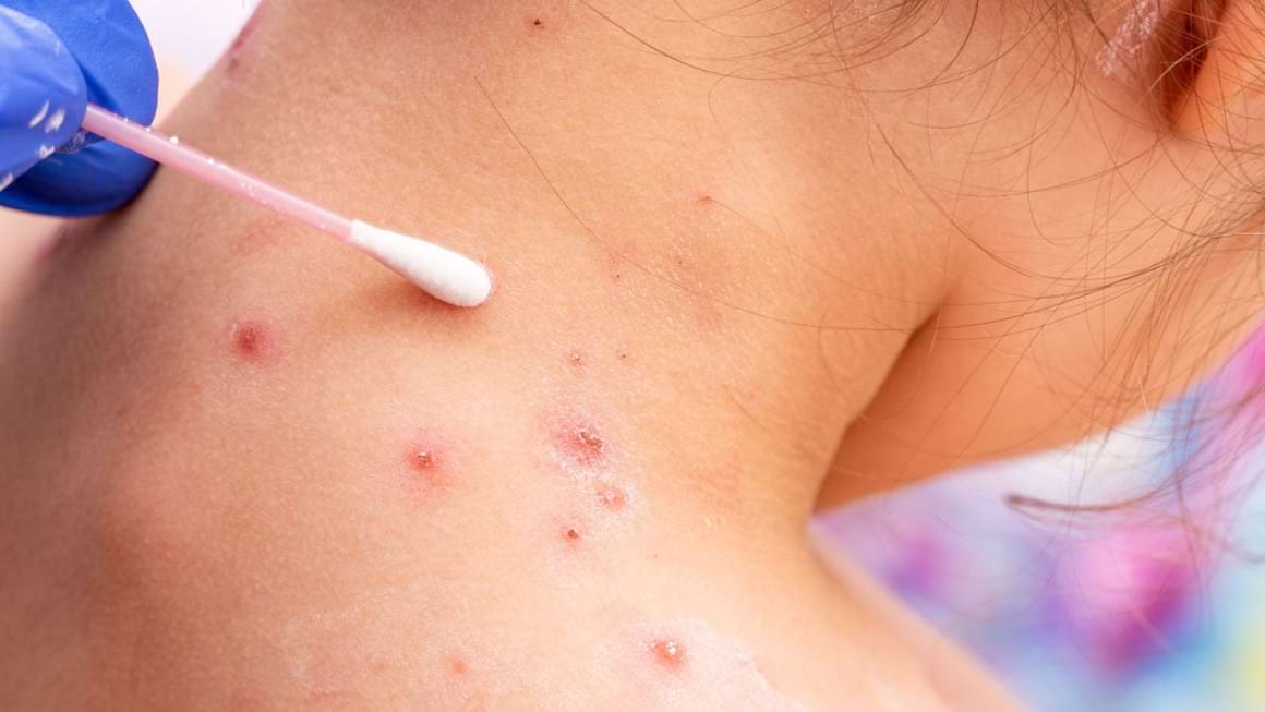 Ministerul Sănătății avertizează: varicela poate evolua imprevizibil, iar encefalita și pneumonia, printre riscurile majore